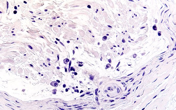 1B4 Anti-MAG Neuropathy (Case 1) Neg Control 60X 1