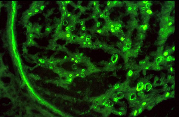 1C2 Anti-MAG (Case 1) Fluorescence - Copy