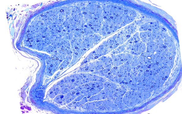 1D1 (B) Anti-MAG NP (Case 1) Plastic 20X 1