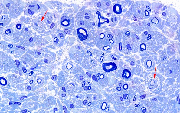 1D4 Anti-MAG NP (Case 1) Plastic 100X 1 copy