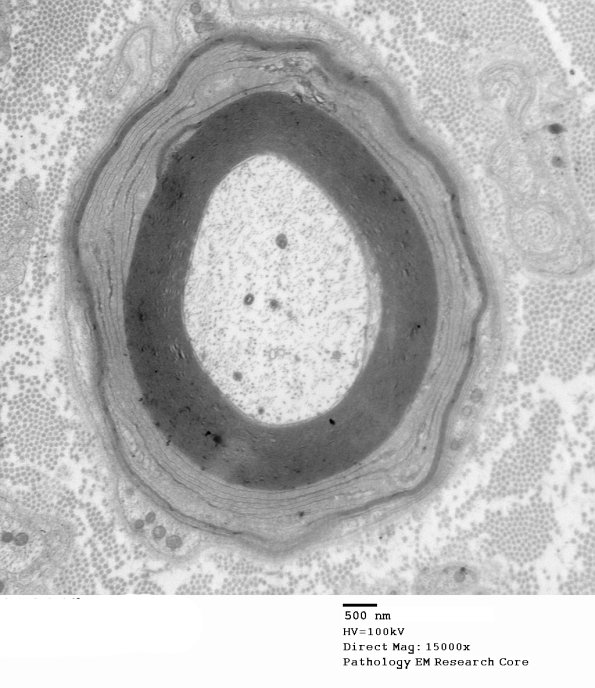 1E11A Anti-MAG NP (Case 1) EM 020 - Copy