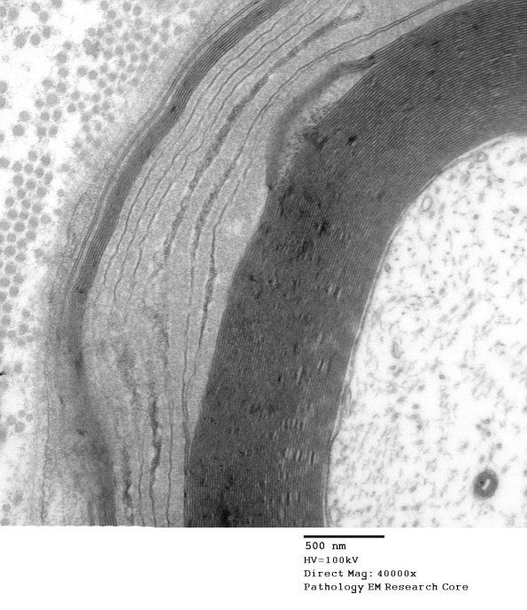 1E11B Anti-MAG NP (Case 1) EM 021 - Copy