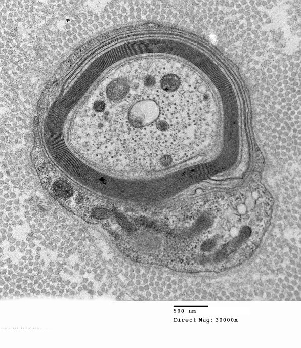 1E12 Anti-MAG (Case 1) _021 - Copy