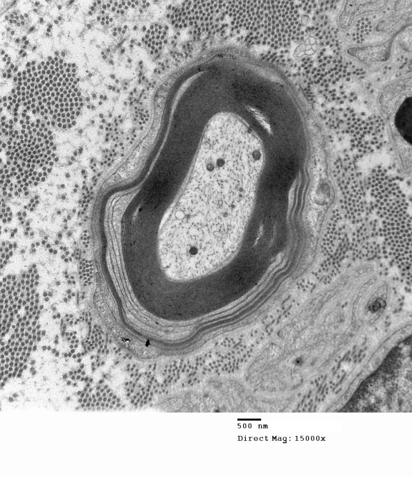 1E13A Anti-MAG (Case 1) 004 - Copy