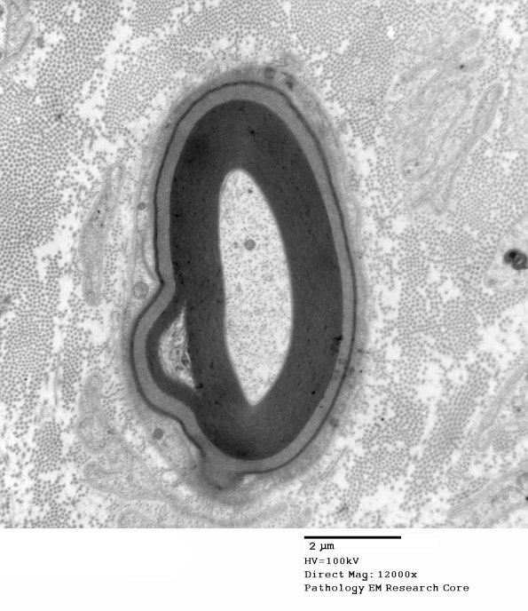1E2A Anti-MAG NP (Case 1) EM 022 - Copy