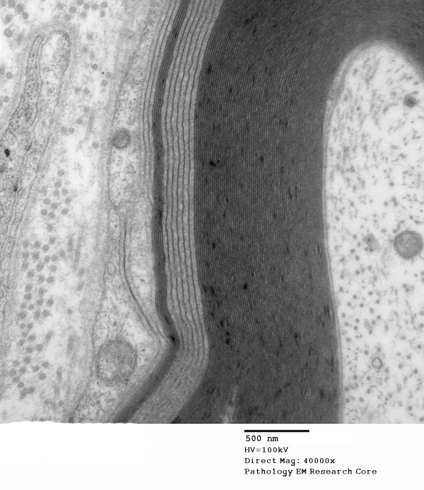 1E2B Anti-MAG NP (Case 1) EM 023 - Copy