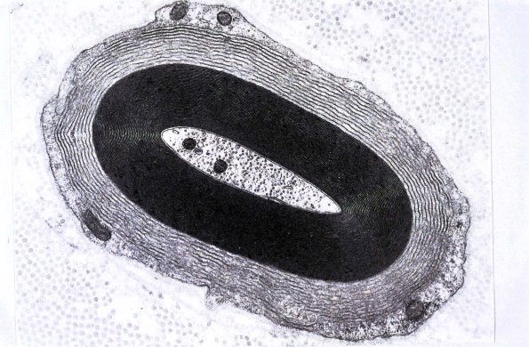 1E3A Anti-MAG Neuropathy 23 - Copy