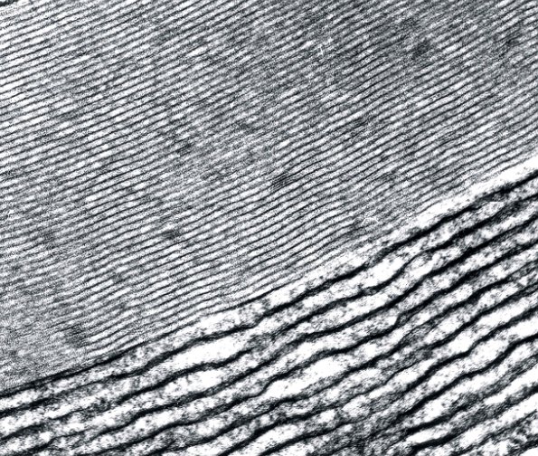 1E3B Anti-MAG Neuropathy EM16 - Copy