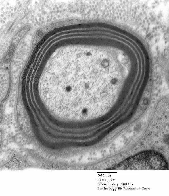 1E4 Anti-MAG (Case 1) 002 - Copy