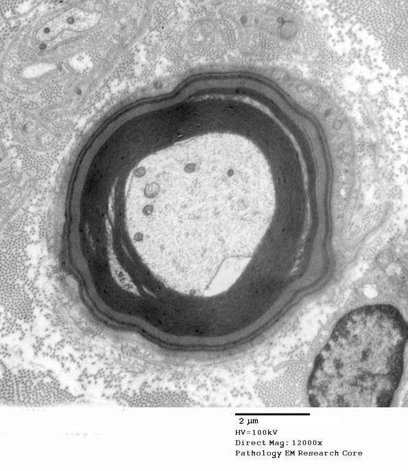 1E5A Anti-MAG (Case 1) 006 - Copy