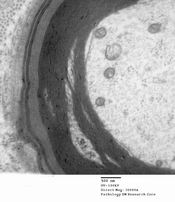 1E5B Anti-MAG (Case 1) 007 - Copy
