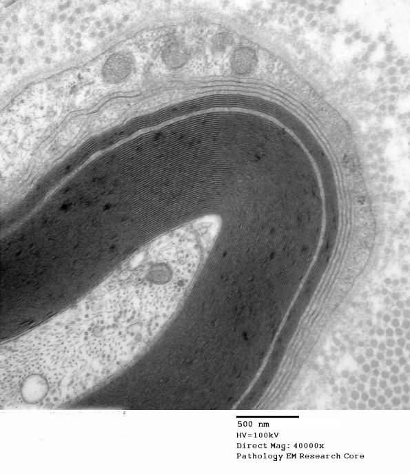1E6B Anti-MAG (Case 1) 014 - Copy