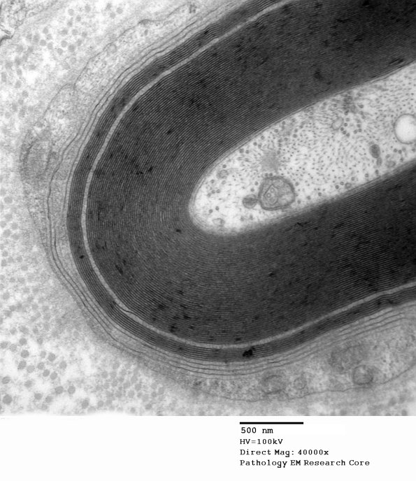 1E6C Anti-MAG (Case 1) 013 - Copy