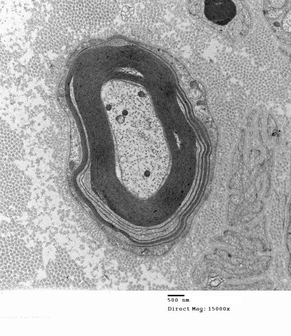 1E7A Anti-MAG (Case 1) 022 - Copy