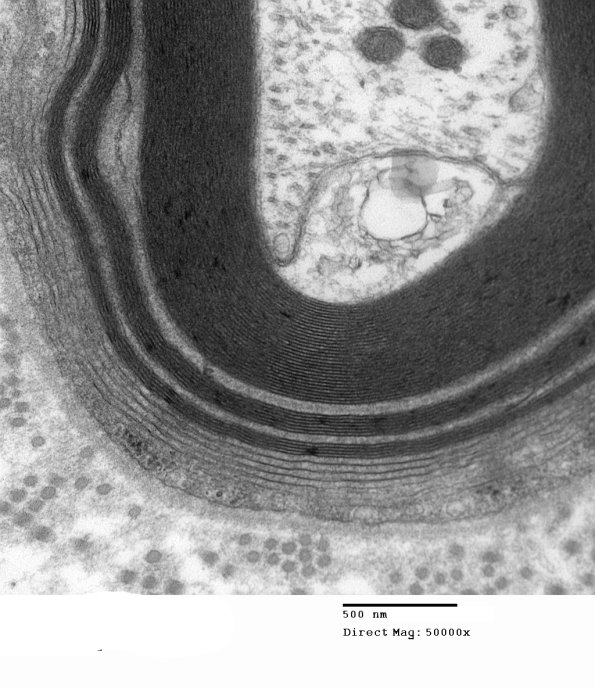 1E8B Anti-MAG NP (Case 1) EM 006 - Copy
