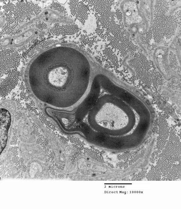 1F1A Anti-MAG (Case 1) _002 - Copy
