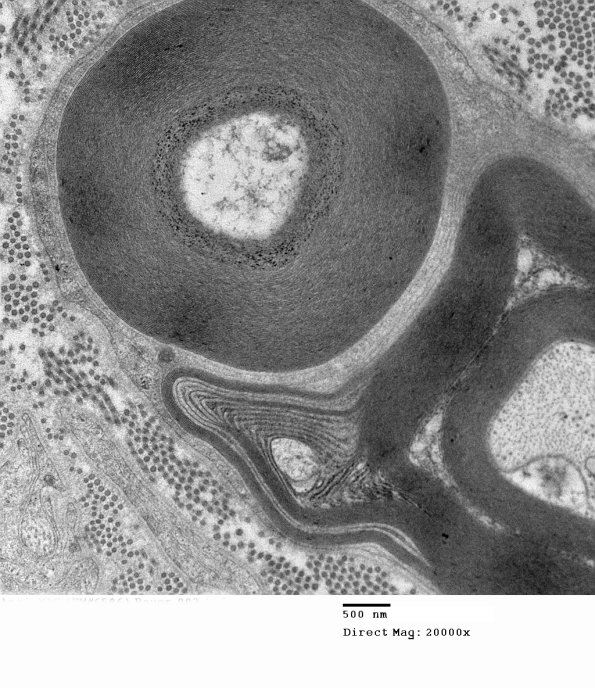 1F1B Anti-MAG (Case 1)_003 - Copy