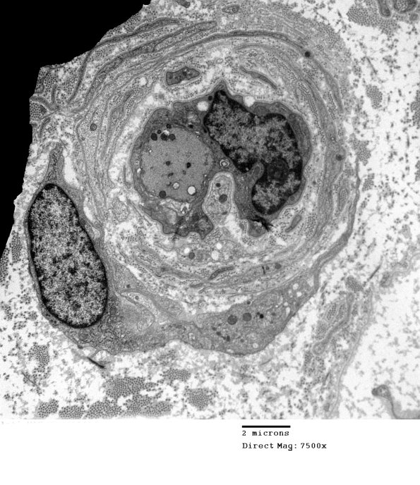 1F2 Anti-MAG (Case 1) #2_013 - Copy A