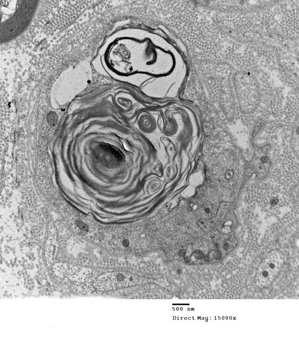 1F3 Anti-MAG (Case 1) #2_002 - Copy A