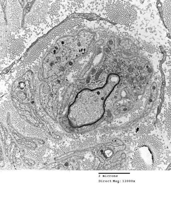1F4 Anti-MAG (Case 1) #2_004 - Copy A