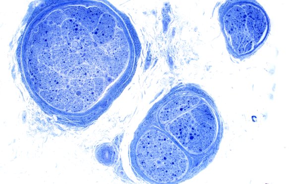 2A1 Anti-MAG (Case 2) Plastic 10X