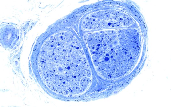 2A2 Anti-MAG (Case 2) Plastic 20X 2