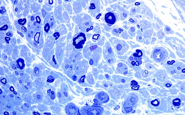 2A3 Anti-MAG (Case 2) Plastic 100X 12