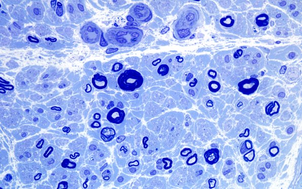 2A4 Anti-MAG (Case 2) Plastic 100X 11