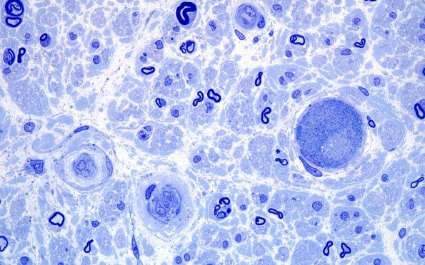 2A5 Anti-MAG (Case 2) Plastic 100X 4