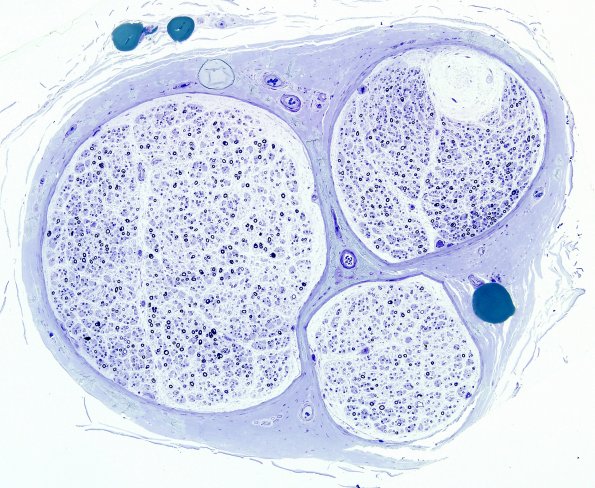 3A1 Anti-MAG Neuropathy (Case 3A) Plastic 5.jpg