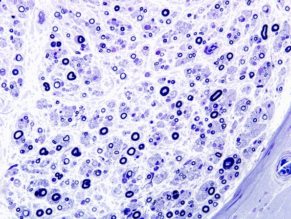 3A2 Anti-MAG Neuropathy (Case 3A) Plastic 8.jpg