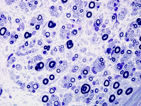 3A3 Anti-MAG Neuropathy (Case 3A) Plastic 9.jpg