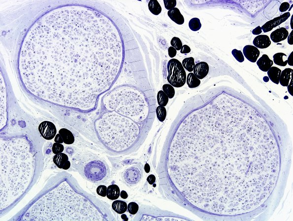 3B1 Anti-MAG Neuropathy (Case 3B) Plastic 5.jpg