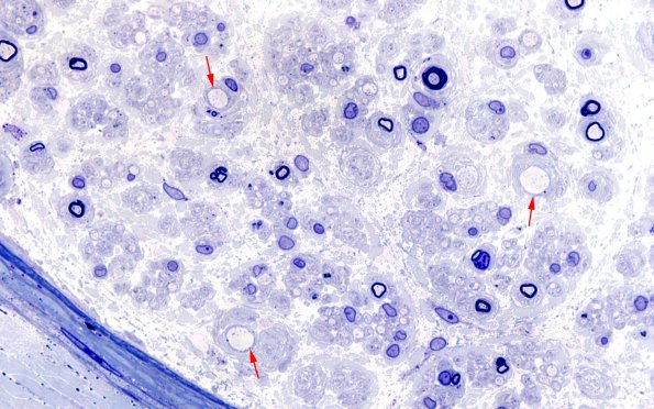 3B2 (Case 3B) Plastic100X 5 copy