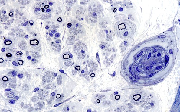 3B3 Neuropathy (Case 3B) 100X 2