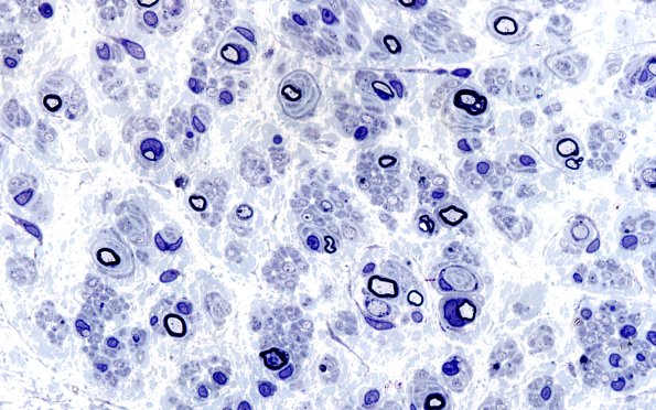 3B4 Renaut bodies (Case 3B)  100X 3