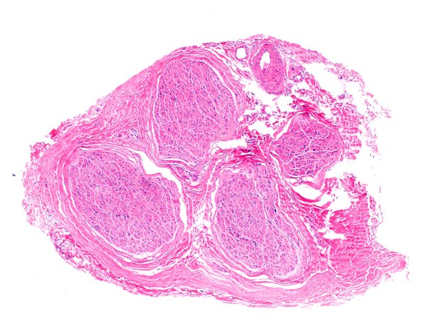 4A1 (Case 4) H&E 4X 1