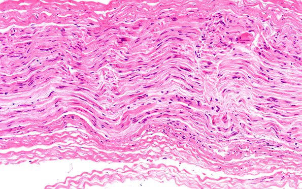 4A3 (Case 4) H&E 20X 1