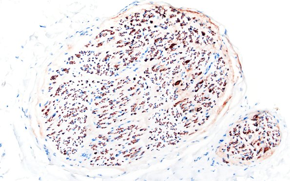 4B (Case 4) NF 20X 1