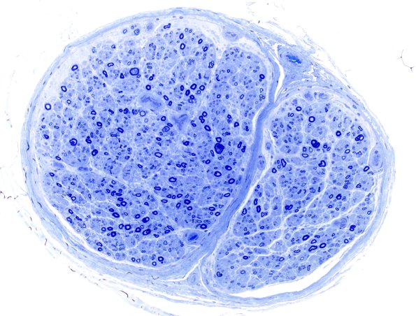 4C2 (Case 4) Plastic 20X