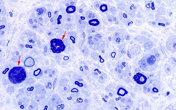 4C5 (Case 4) Plastic 100X 13 copy