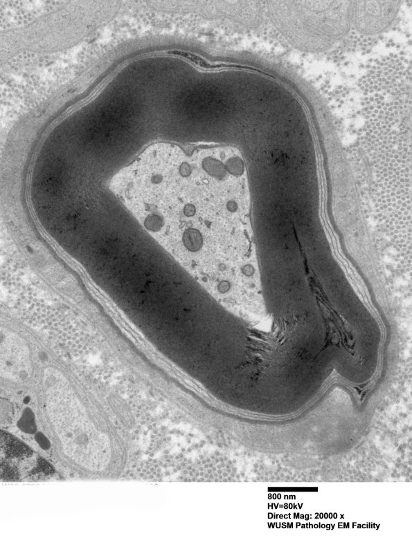 4D1 (Case 4) Nerve_026 - Copy