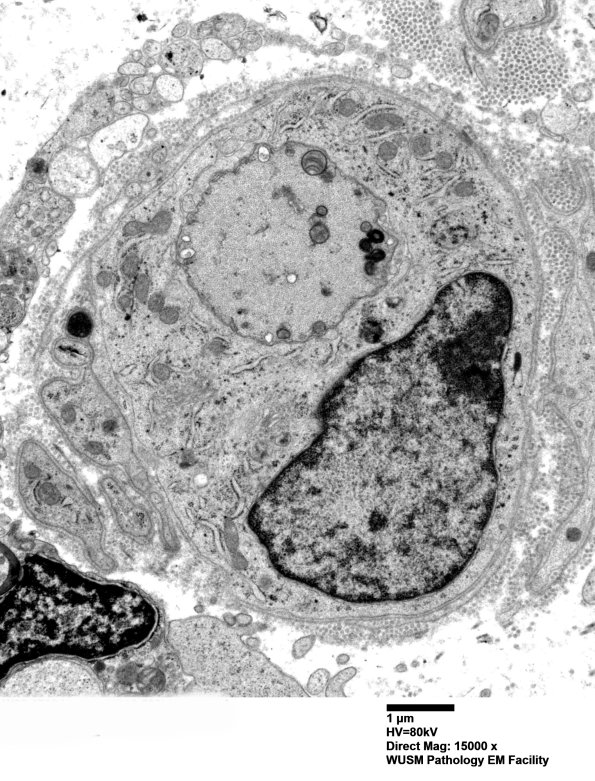 4D4 (Case 4) Nerve_014 - Copy