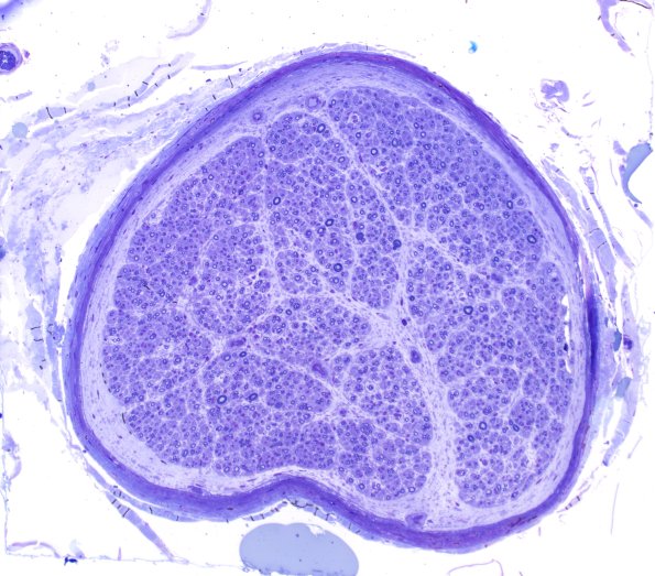 5A1 Paraprotein, AxDegen, Demyel, (Case 5) Plastic 10X 1