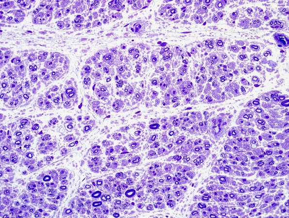 5A2 Paraprotein, AxDegen, Demyel, (Case 5) Plastic 1.jpg