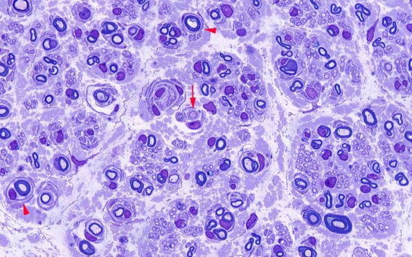 5A3 Paraprotein, AxDegen, Demyel, (Case 5) Plastic 100X 1 copy