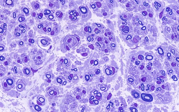 5A3 Paraprotein, AxDegen, Demyel, (Case 5) Plastic 100X 1