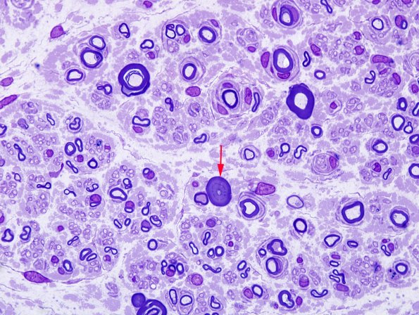 5A4 Paraprotein, AxDegen, Demye, (Case 5) Plastic 1 (2) copy.jpg