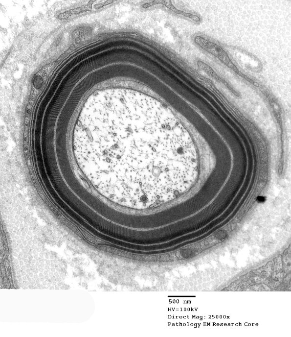 5B1 Wide space myelin (WSM), OBN (Case 5) EM 037 - Copy