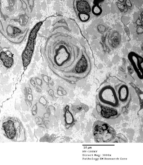 5C1 Paraprotein, AxDegen, Demyel (Case 5) EM 015 - Copy